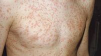 ieExplains: Measles — Here is what you need to know