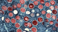ieExplains: What is mpox, where are the outbreaks and what is the WHO doing?