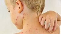 Little boy scratching me his chickenpox