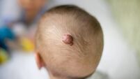 Hemangioma in the head