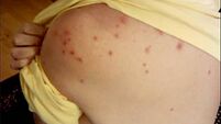 HSE issues measles alert for passengers on Dublin to Sligo train